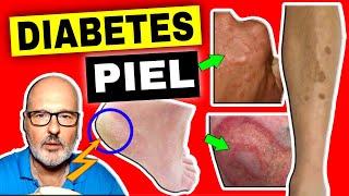 15 SIGNOS de DIABETES en la PIEL que no debes ignorar