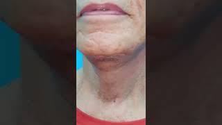 NECKLIFT | Dr. Umang Kothari | Plastic Surgeon