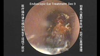 Childhood earwax embolism, soaked in ear drops and softened before cleaning 20241209