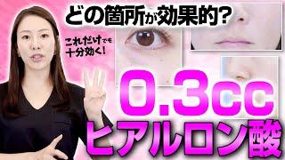 ヒアルロン酸０.３ccをどこに使えば若返るかを解説します。