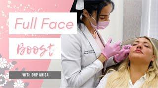 FULL FACE BOOST By DNP Anisa (Watch entire journey of Botox + Lip, Cheek, & Smile Line Fillers)