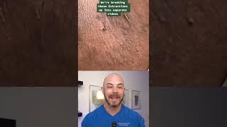 Derm reacts to armpit cyst removal! #dermreacts #doctorreacts #HS #cyst