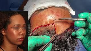 Forehead Reduction Surgery (Hairline Lowering Surgery) by Dr. Philip Solomon in Toronto