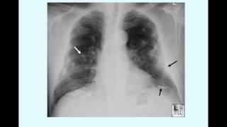 Asbestosis - CRASH! Medical Review Series