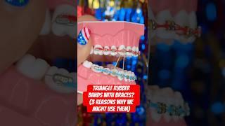 TRIANGLE RUBBER BANDS WITH BRACES? #braces #teeth #asmr