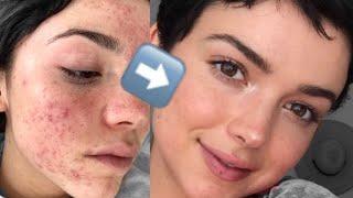 HOW I HEALED MY ACNE WITH FOOD || Bekah Martinez