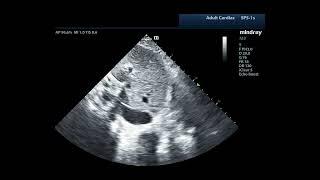 How to... Measure IVC Diameter