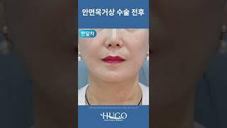 안면거상 수술 전후 공개! 팔자주름, 볼처짐 개선