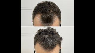 FUE & DHI Hair Transplant London 1321 grafts