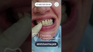 Имплантация зубов пациенту. Особый случай.