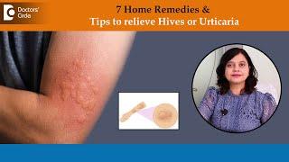 7 Home Remedies to Get Rid of Hives Fast | Urticaria Treatment -Dr.Amee Daxini |Doctors' Circle