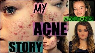 My ACNE Story + Going on ACCUTANE?!