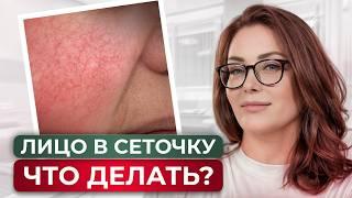 Как избавиться от сосудов на лице? ЛУЧШЕЕ ЛЕЧЕНИЕ КУПЕРОЗА И РОЗАЦЕА!