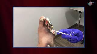 WCW: Amputating Necrotic Toes after Frostbite Injury