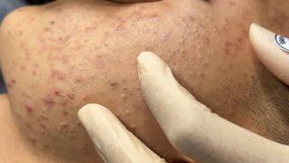 Blackheads & Whiteheads Removal New 2024 | Acne Treatment With Bo Nguyễn Spa #007