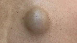 超巨型粉瘤手術 美麗新城診所莊禮謙醫師 huge epidermal cyst minimal incision Dr George