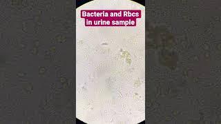 Bacteria and Rbcs in urine under microscope (40x view) #Pathology