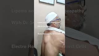 lipoma, lymph nodes, neuro fibro metatiasis, cervical lymph nodes and electro homoeopathy