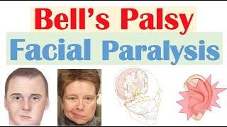 Bell’s Palsy (Facial Paralysis) | Causes, Pathophysiology, Signs & Symptoms, Diagnosis, Treatment