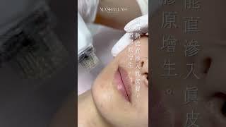 【銅鑼灣 Mashallah Beauty】 重拾少女肌｜告別黑頭粉刺 一次解決90%肌膚問題 皮膚急救方法 #美容 #肌膚 #暗瘡 #黑頭 #皮膚暗啞 #膠原蛋白 #美白