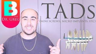 [BRACES EXPLAINED] TADs / Mini Implants