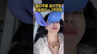 팔자주름 실리프팅 시술영상 직후, 2주 #비포애프터 #실리프팅 #시술