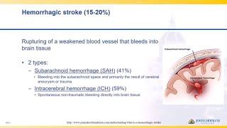 Hemorrhagic Stroke | Lisa Klein