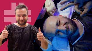 Maximum Density Hair Transplant