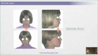 The Case Against Facial Muscle Strain - William M. Hang, DDS, MSD