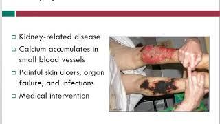 Calciphylaxis | Wound Care Topics | Free Wound Care Info | WoundEducators.com