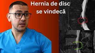 Dovada că hernia de disc se vindecă