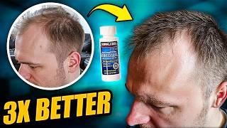 Minoxidil Not Working? - Try THIS for MORE hair growth!