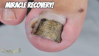  UNBELIEVABLE RECOVERY! #nails #ingrowntoenail