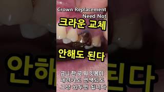 크라운교체하면 과잉진료 입니다. 변색인데 멀쩡한 크라운 왜 뜯어? 07_2024_04_23