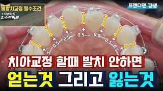 비발치교정 장점과 단점을 정확하게 알려드립니다.