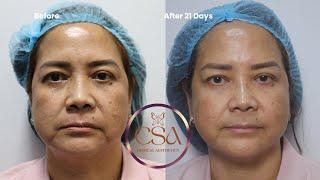 Painless RF microneedling for wrinkles and saggy skin