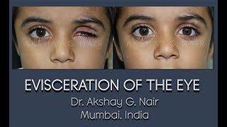 Ocular Evisceration (Eye Removal) HD Video: Dr Akshay G Nair, Mumbai