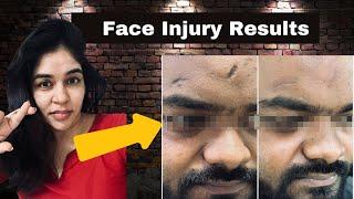 Injury scar on face treatment by lasers and surgery- 9999 747 717