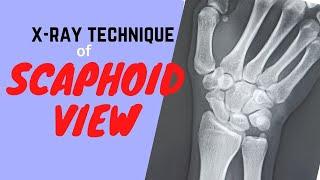 Technique of Scaphoid view (Ep-45) | X-ray scaphoid bone | procedure of Scaphoid views |Tutorial