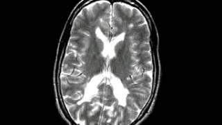 Inflammatory Multiple sclerosis