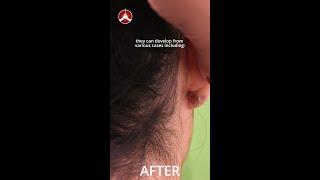 What Causes Keloids? | Dr. U Hair and Skin Clinic