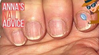 How To Care For Ridgy Nails  [ANNA'S NAIL ADVICE] ️‍️