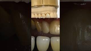 Lateral Amber Press Veneer @EnvisiontecMain #envisiontec #lsk121shorts #dental #teeth