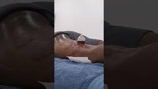Wet Cupping (Hijama) Timelapse!