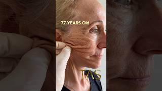 77 Years Old to 30 Years Old by Prof.TAS with Scarless #Facelift