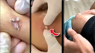 WATCH THESE PIMPLES AND BLACKHEADS EXPLODE! 