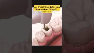 Are White Fillings Better Than Silver Fillings? #shorts #dentist #asmrdentist #music#toothfilling