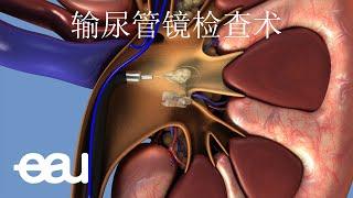 输尿管镜手术 (Ureteroscopy - URS)