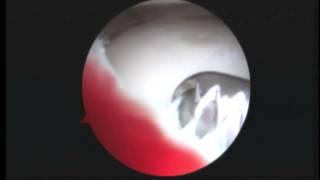 MR Bilateral knee scopes, L Knee discoid lat meniscus12.19.13