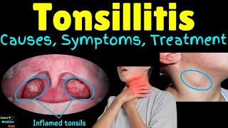 Tonsillitis – Causes, Symptoms, Diagnosis, Treatment, Complications & Prevention